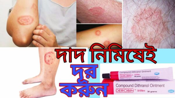 Compound Dithranol Ointment 30 GM (Derobin Cream) - Image 5