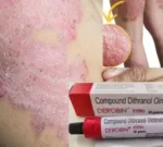 Compound Dithranol Ointment 30 GM (Derobin Cream) - Image 4