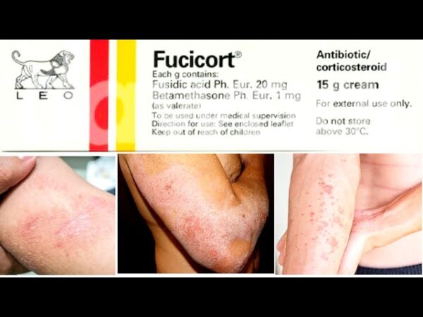 Fucicort Cream (Fusidic Acid/Betamethasone) - Image 4