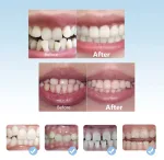 White silicone orthodontic retainer trainer for teeth straightening