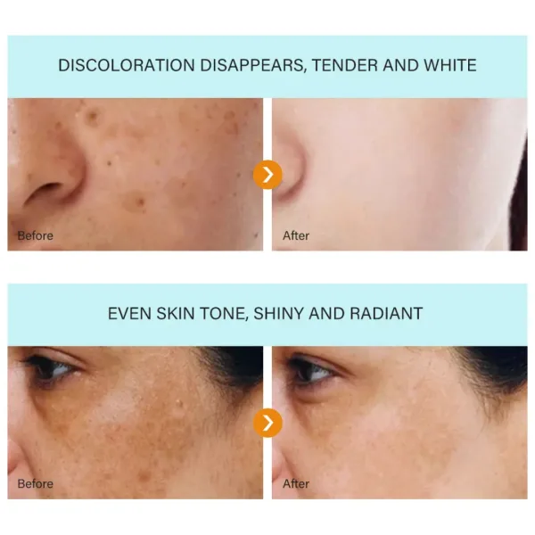 MOOYAM dark spot removal freckle cream 30g